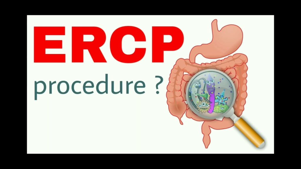 ERCP prcedure